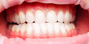Professional Whitening Teeth