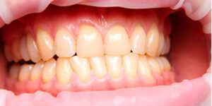 whitening teeth