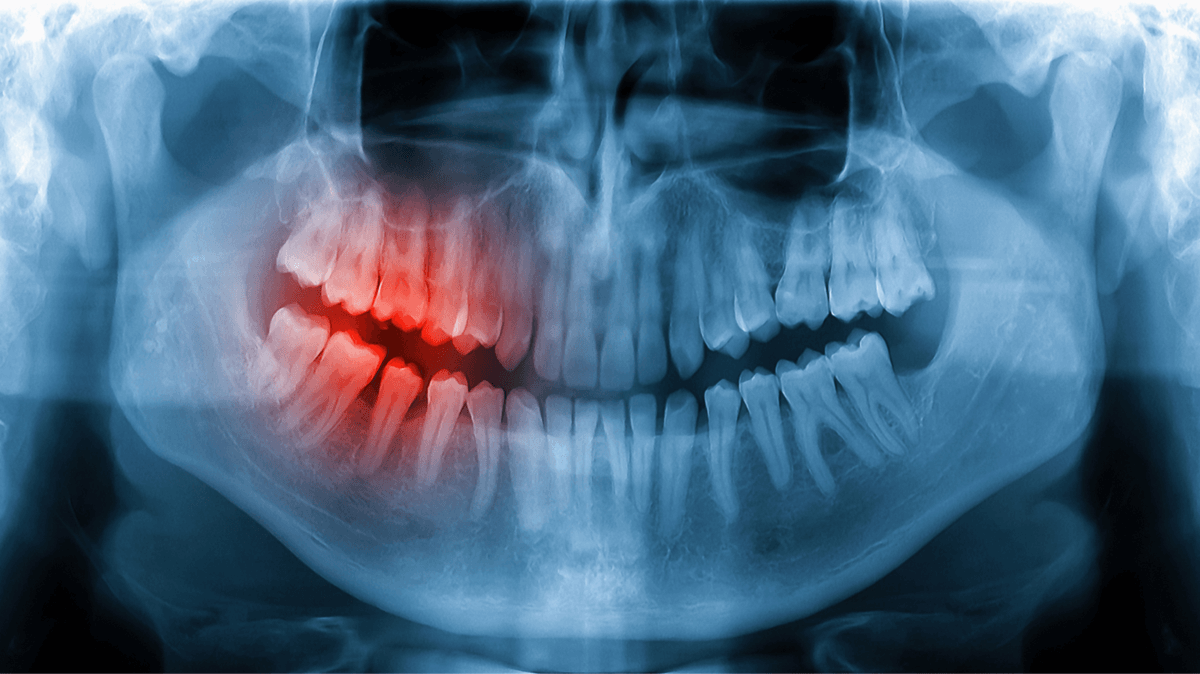 infected and cracked tooth with abcess in a dental x ray