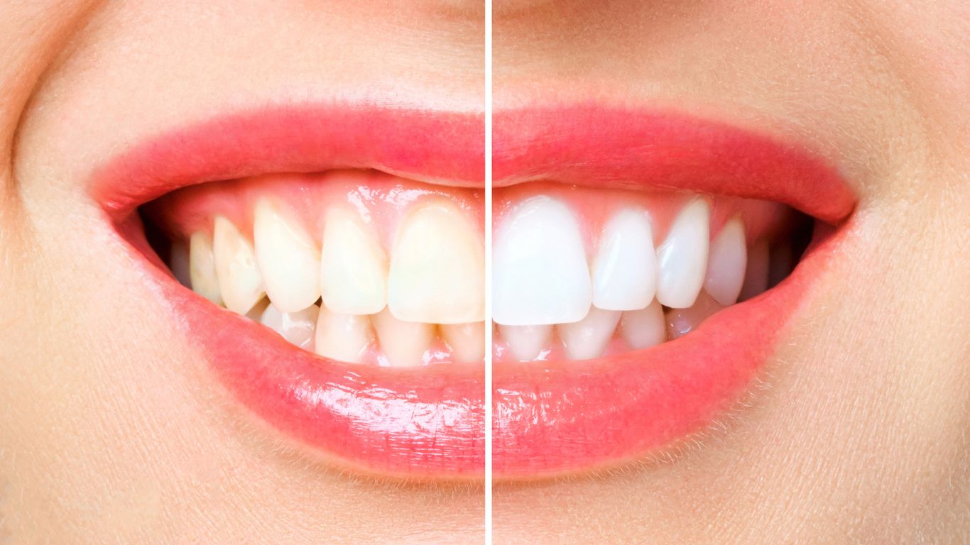 teeth whitening for teeth with dental restorations