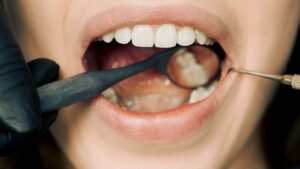 Bleeding Gums