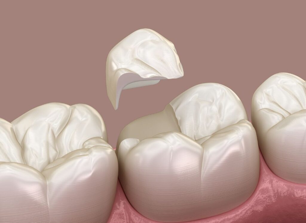 Onlay ceramic crown