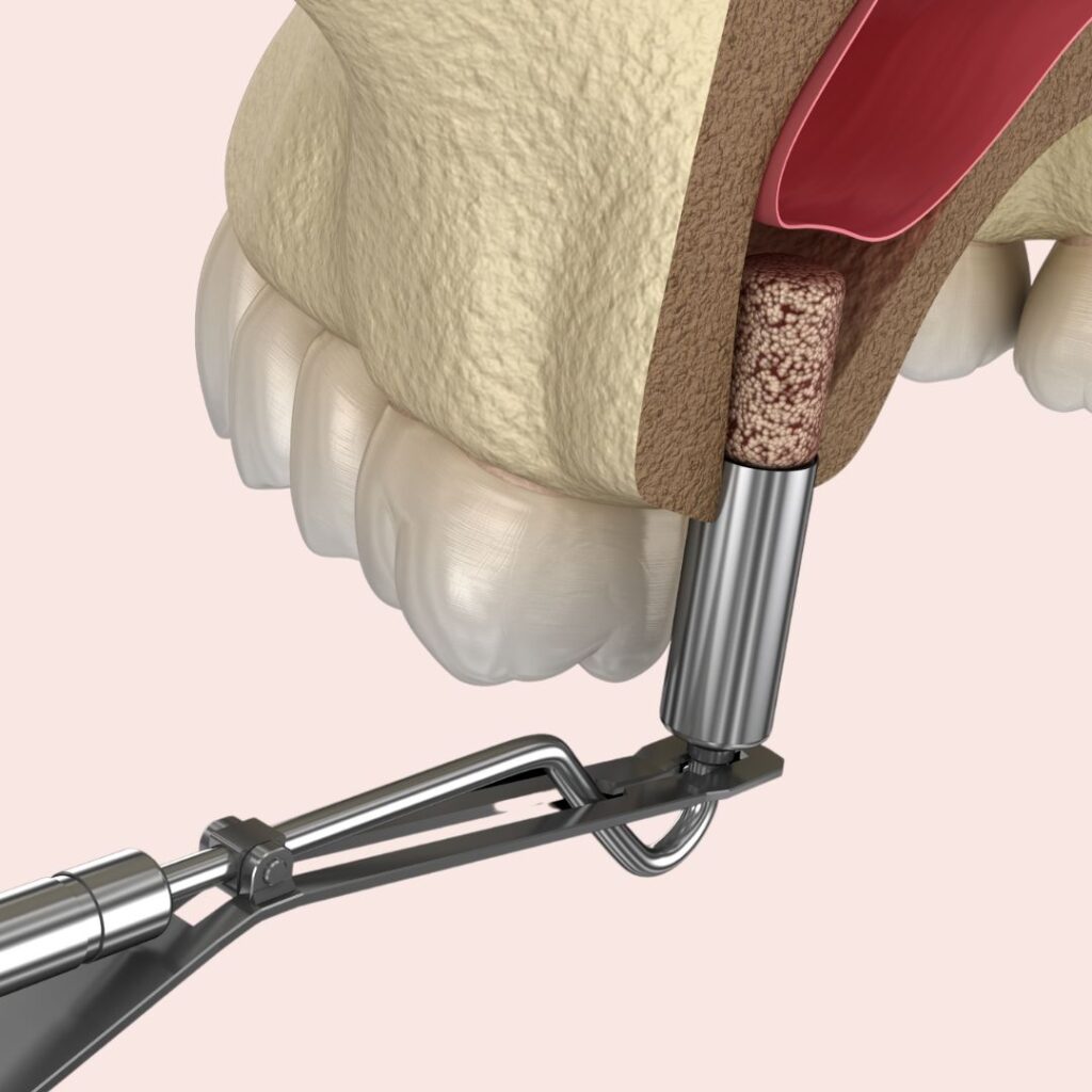 Sinus Lift Surgery