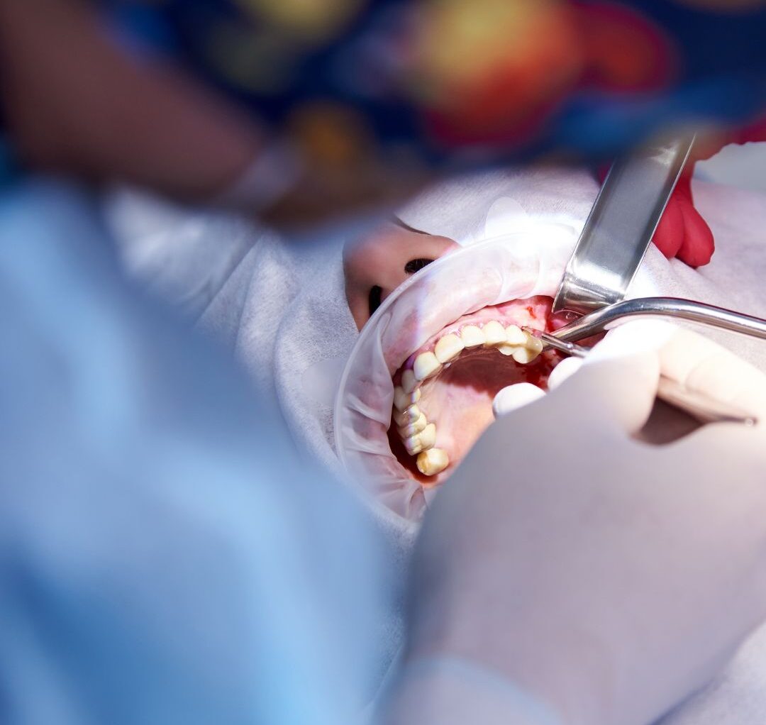 Sinus lifting operation