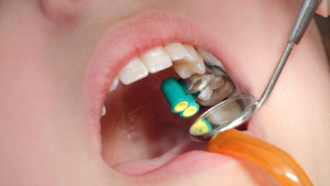 chipped or broken dental filling