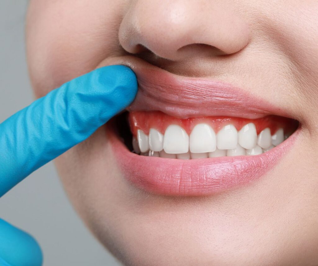 gum contouring for gummy smile