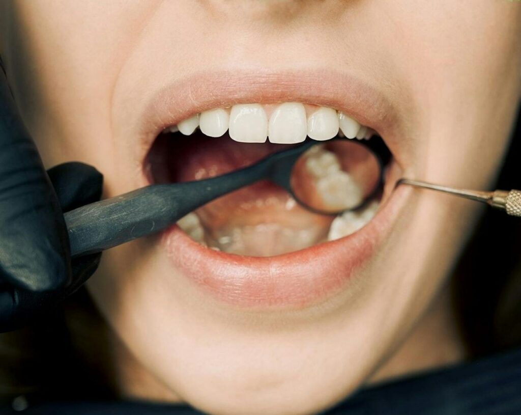 Dental Fillings Cost in Bundoora
